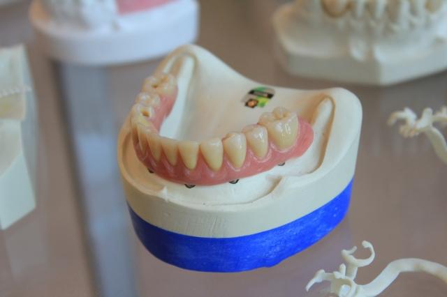 SLA vs. RBM Surfaces: How Implant Surface Technology Shapes Healing